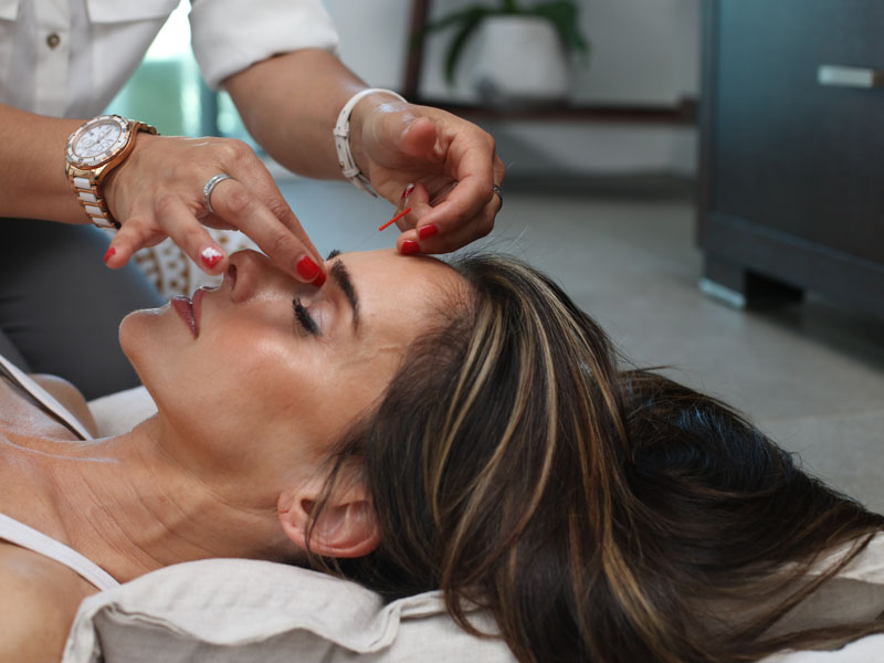 acupuncture